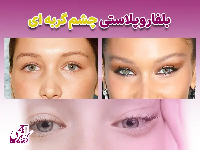 کانتوپلاستی