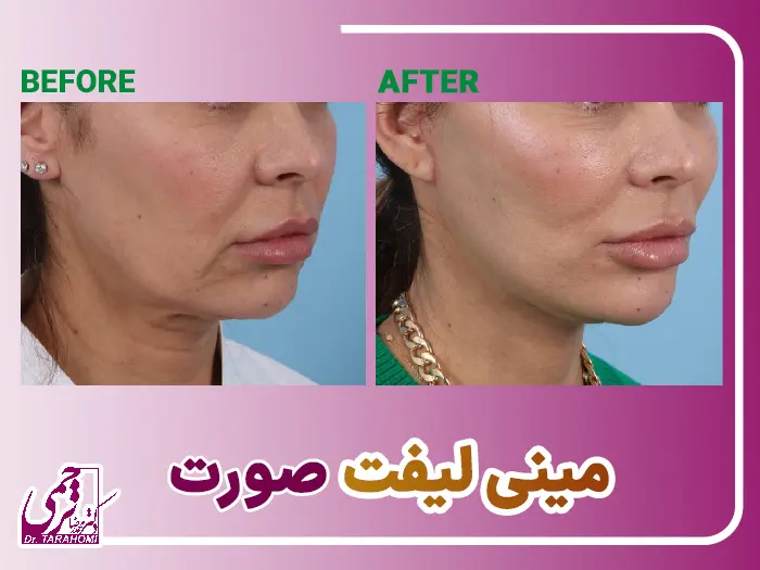 مینی لیفت