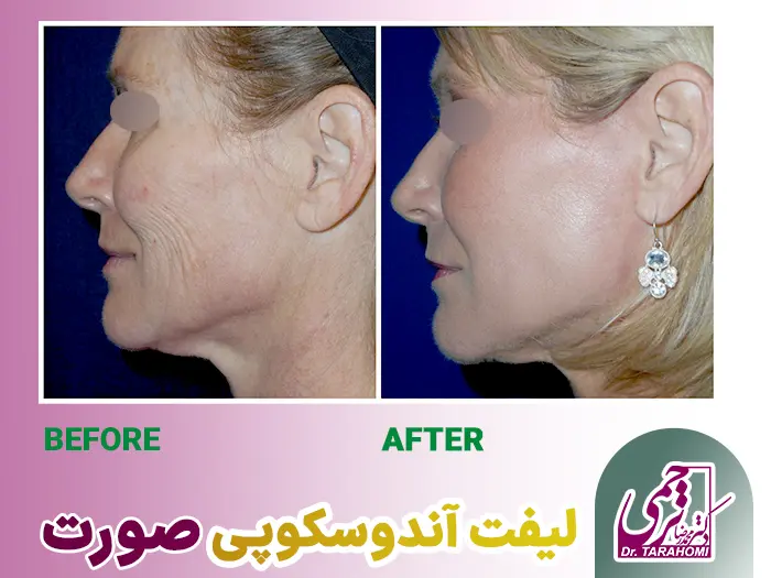 جراحی لیفت آندوسکوپی صورت