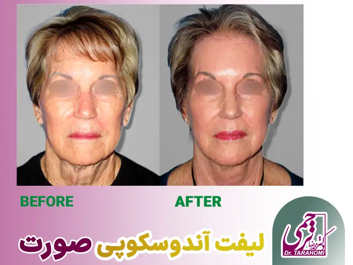 لیفت آندوسکوپی صورت