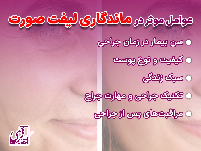 ماندگاری لیفت صورت