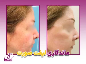 ماندگاری جراحی لیفت صورت