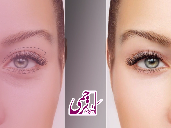 بهترین سن بلفاروپلاستی