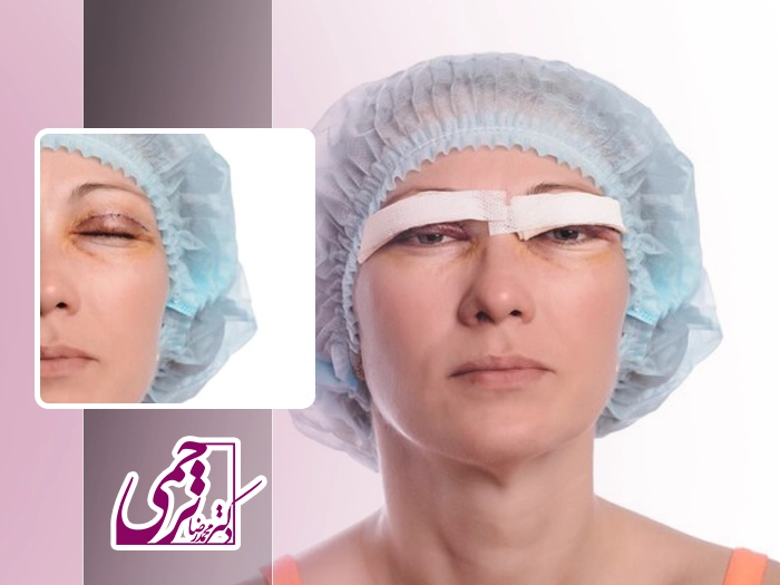 جای بخیه بعد بلفاروپلاستی