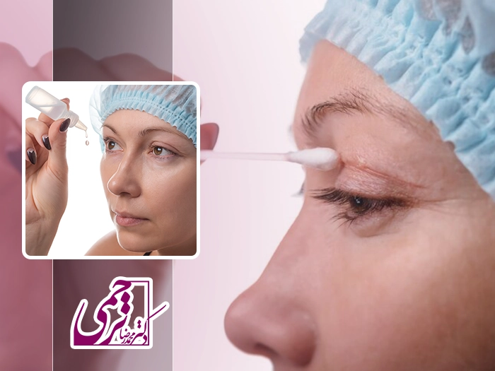 مراقبت های بعد بلفاروپلاستی