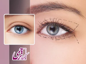 مراقبت های بلفاروپلاستی