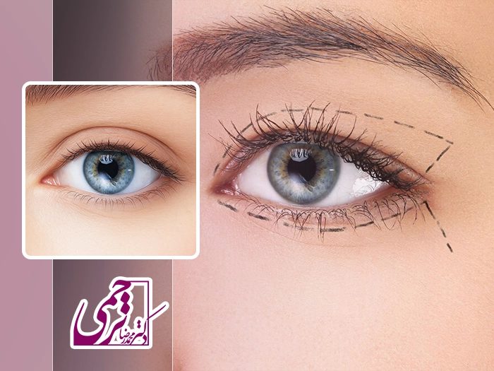 مراقبت های بلفاروپلاستی