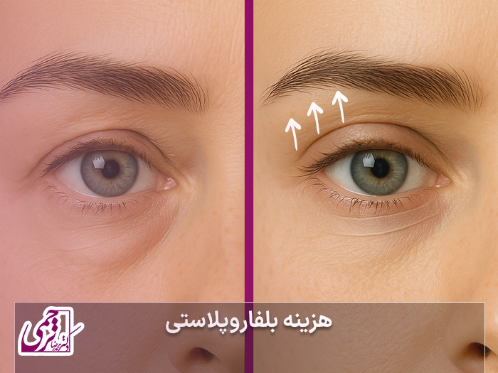 هزینه بلفاروپلاستی