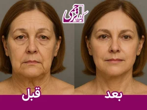 فیلم لیفت صورت