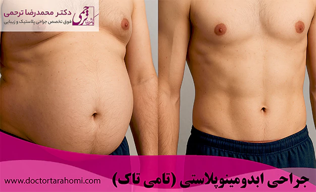 جراحی ابدومینوپلاستی