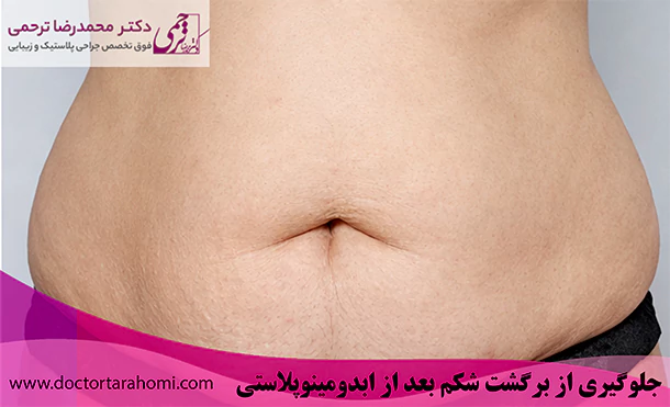 جلوگیری از برگشت شکم بعد از ابدومینوپلاستی